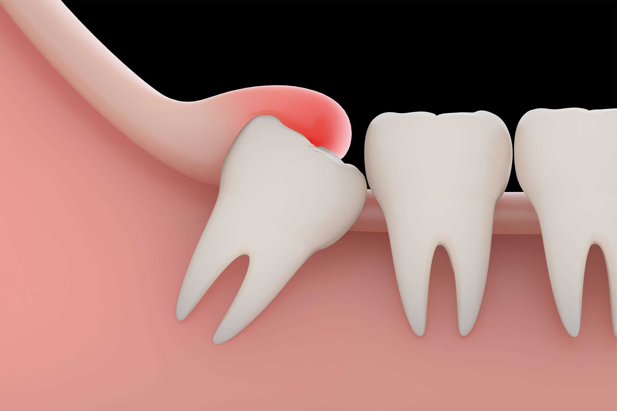 Understanding the Common Reasons for Wisdom Tooth Extraction